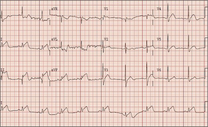 Septal Infarct